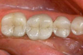 Fillings after